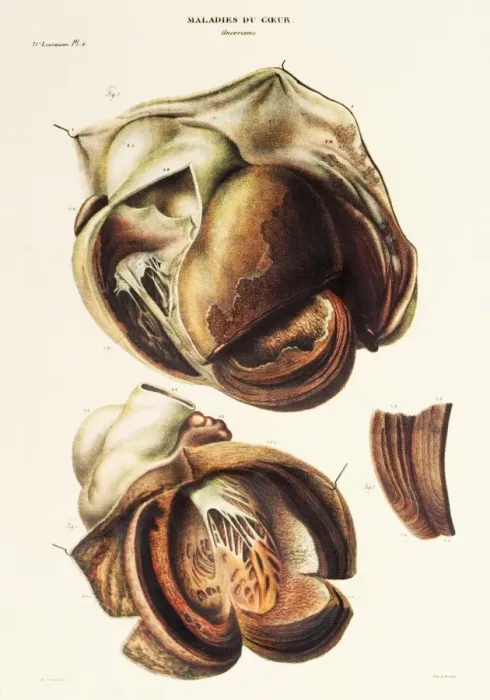 Gerahmter Druck : Aortenaneurysma Gerahmter Druck : Aortenaneurysma