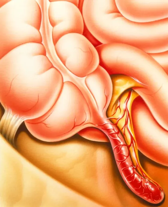 Gerahmter Druck : Bild eines Appendix mit Appendizitis Gerahmter Druck : Bild eines Appendix mit Appendizitis