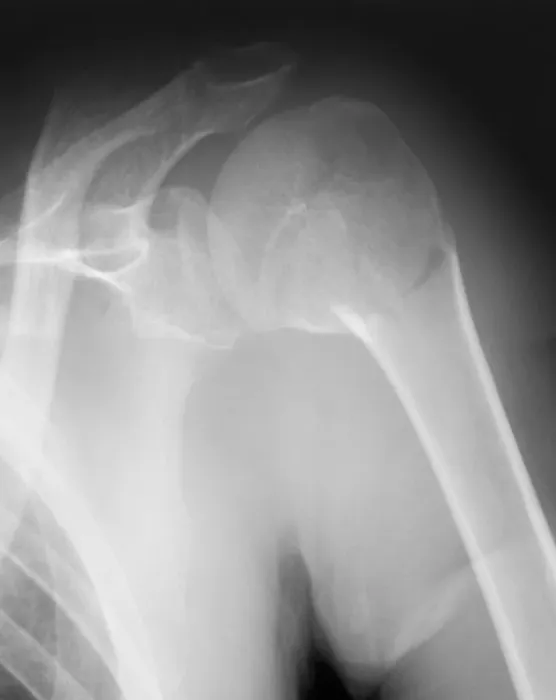 Gerahmter Druck : Brachial Schulter, Röntgenbild Gerahmter Druck : Brachial Schulter, Röntgenbild