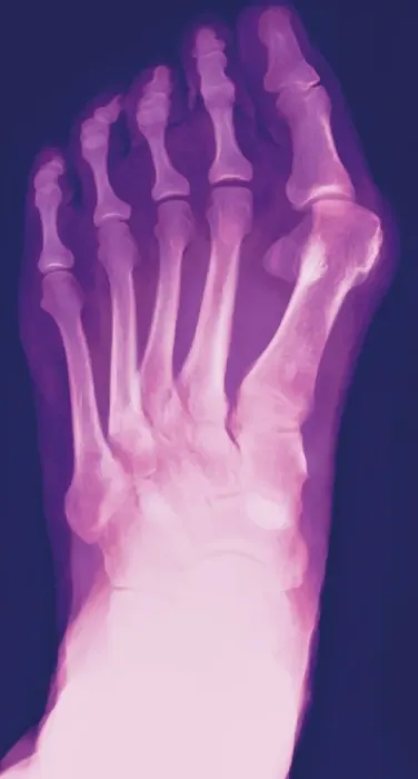 Gerahmter Druck : Bunions X-Ray Gerahmter Druck : Bunions X-Ray
