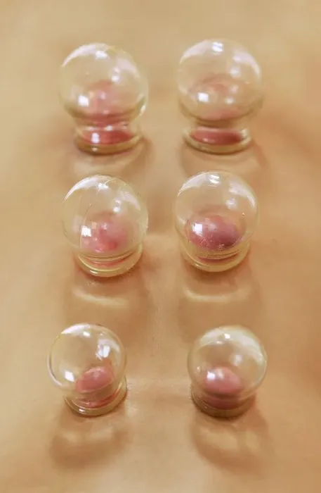 Gerahmter Druck : Cupping. MODELL FREIGEBEN. Kuppelung. Die Kuppelung oder Feuerkuppen ist eine Praxis Gerahmter Druck : Cupping. MODELL FREIGEBEN. Kuppelung. Die Kuppelung oder Feuerkuppen ist eine Praxis