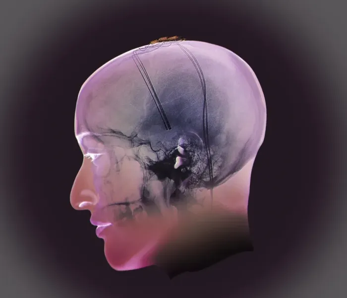 Gerahmter Druck : Tiefenhirnstimulation, Röntgenstrahlen Gerahmter Druck : Tiefenhirnstimulation, Röntgenstrahlen