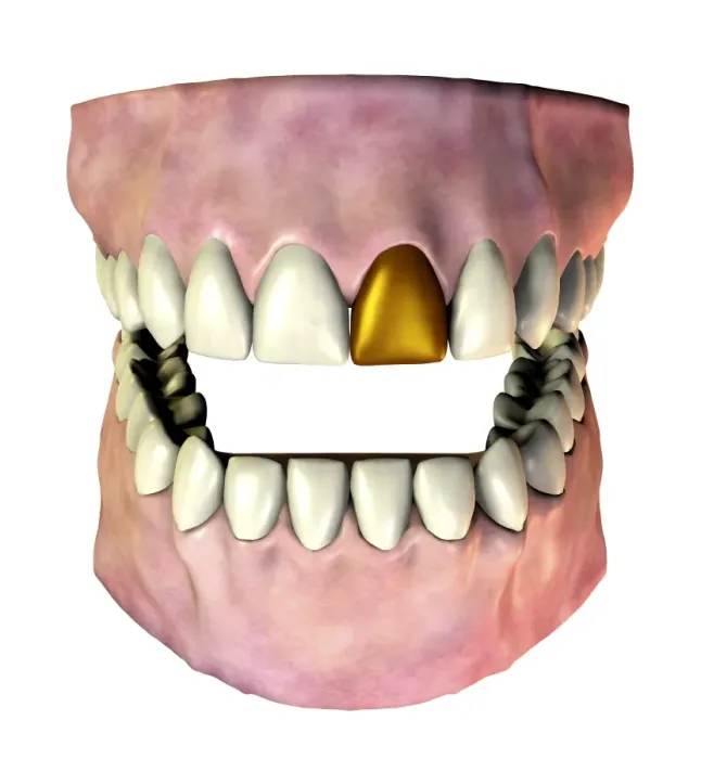 Gerahmter Druck : Gold tooth Gerahmter Druck : Gold tooth