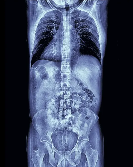 Gerahmter Druck : Menschliches Torso, MRT-Scan Gerahmter Druck : Menschliches Torso, MRT-Scan