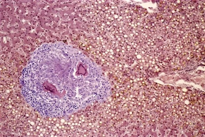 Gerahmter Druck : Lebertuberkulose, lebendiger Mikroskopbild