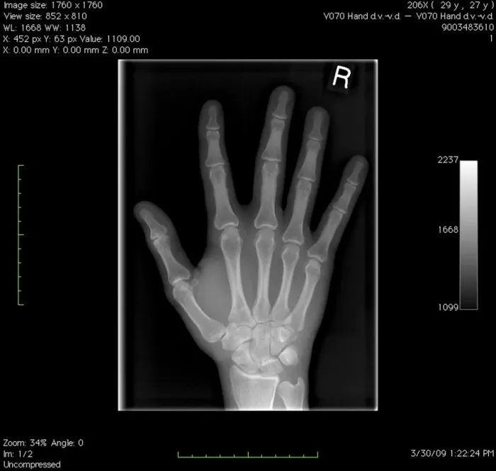 Gerahmter Druck : Normale Hand, digitales Röntgenbild Gerahmter Druck : Normale Hand, digitales Röntgenbild