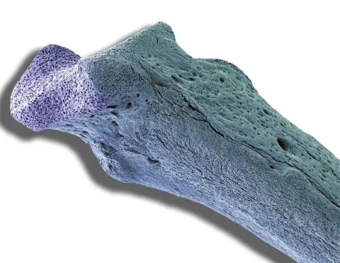 Gerahmter Druck : Knochen mit Osteoporose im SEM Gerahmter Druck : Knochen mit Osteoporose im SEM