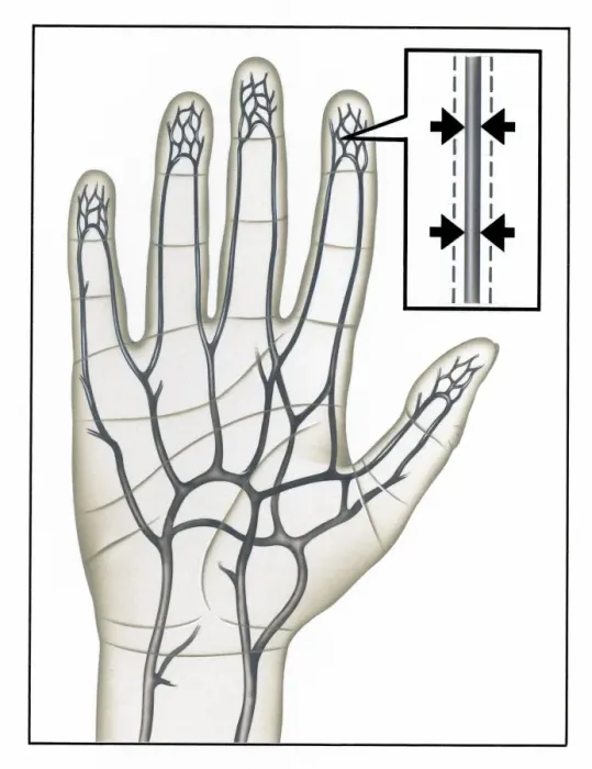 Gerahmter Druck : Raynaud's Krankheit Gerahmter Druck : Raynaud's Krankheit