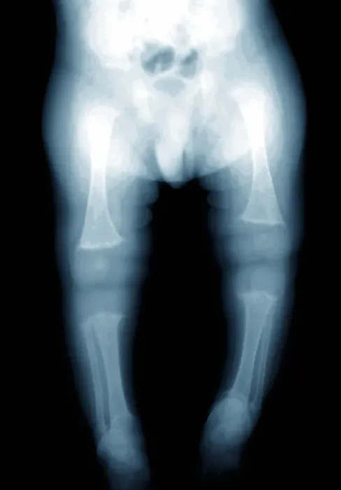 Gerahmter Druck : Rickets - Röntgenbild Gerahmter Druck : Rickets - Röntgenbild
