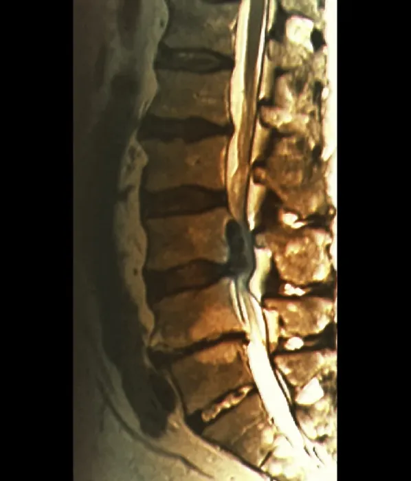 Gerahmter Druck : Sciatica, MRT-Scan Gerahmter Druck : Sciatica, MRT-Scan