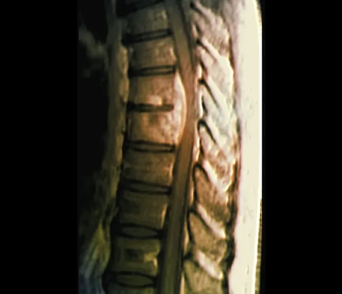 Gerahmter Druck : Spondylosidozitis, MRT-Scan Gerahmter Druck : Spondylosidozitis, MRT-Scan