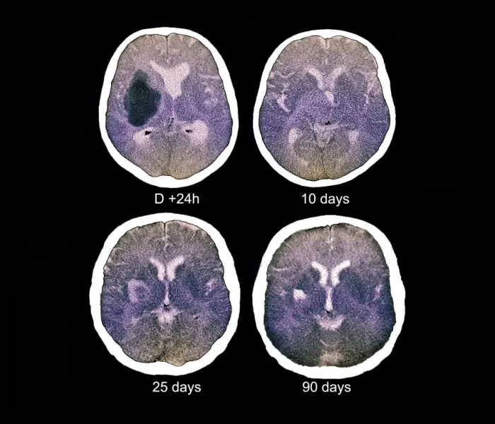 Gerahmter Druck : Schlag, CT-Scans Gerahmter Druck : Schlag, CT-Scans