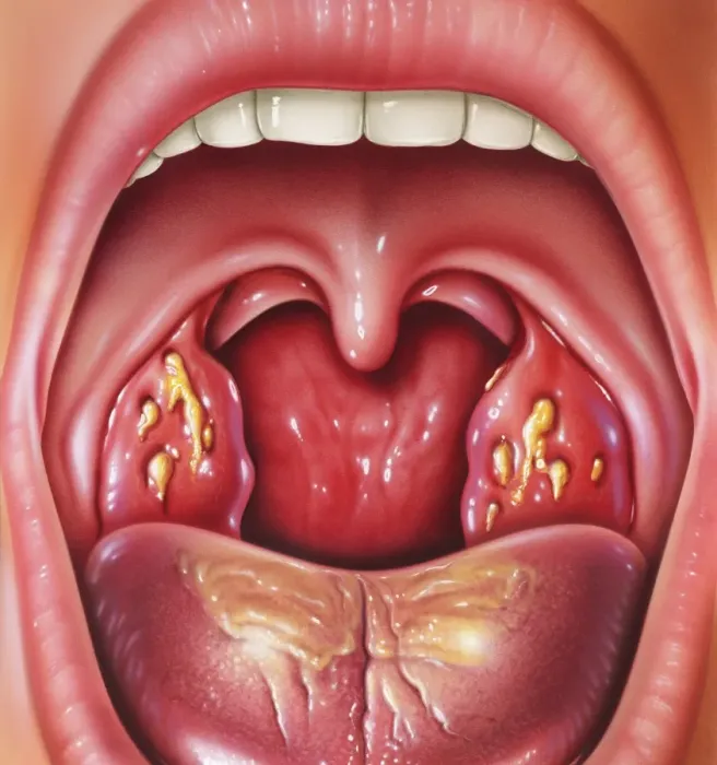 Gerahmter Druck : Tonsillitis Gerahmter Druck : Tonsillitis