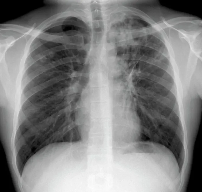 Gerahmter Druck : Tuberkulose, Röntgenbild Gerahmter Druck : Tuberkulose, Röntgenbild