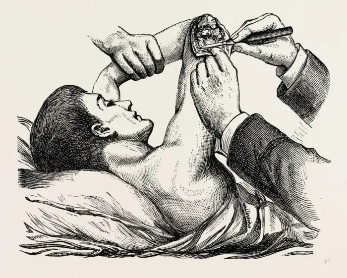 Gerahmter Druck : Entfernung des Gelenks der Ellenbogenbeugeung, Klarstellung des Humerus, medizinische Ausrüstung, chirurgisches Werkzeug Gerahmter Druck : Entfernung des Gelenks der Ellenbogenbeugeung, Klarstellung des Humerus, medizinische Ausrüstung, chirurgisches Werkzeug