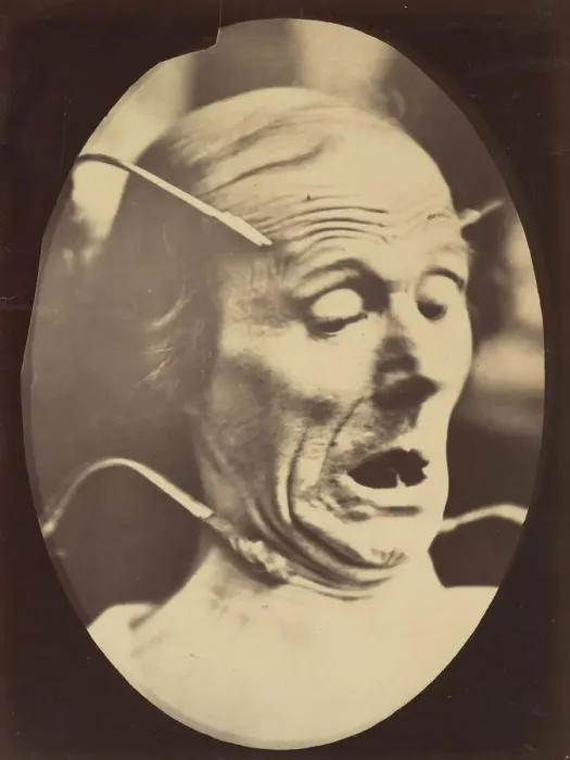 Gerahmter Druck : Figur 62: Angst im Profil (Terror), Kostüm und Druck von 1854 bis 1856 gelegt; gedruckt wurde es jedoch erst um das Jahr 1862, Erfindung der französischen Physikerin Duchenne de Boulogne Gerahmter Druck : Figur 62: Angst im Profil (Terror), Kostüm und Druck von 1854 bis 1856 gelegt; gedruckt wurde es jedoch erst um das Jahr 1862, Erfindung der französischen Physikerin Duchenne de Boulogne