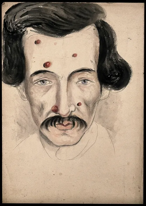 Gerahmter Druck : Kopf eines Mannes mit einer Krankheit, die sein Gesicht betrifft, 1800-1899. Künstler: Christopher D'Alton. Kopf eines Mannes mit einer Krankheit, die sein Gesicht betrifft, 1800-1899. Künstler: Christopher D'Alton