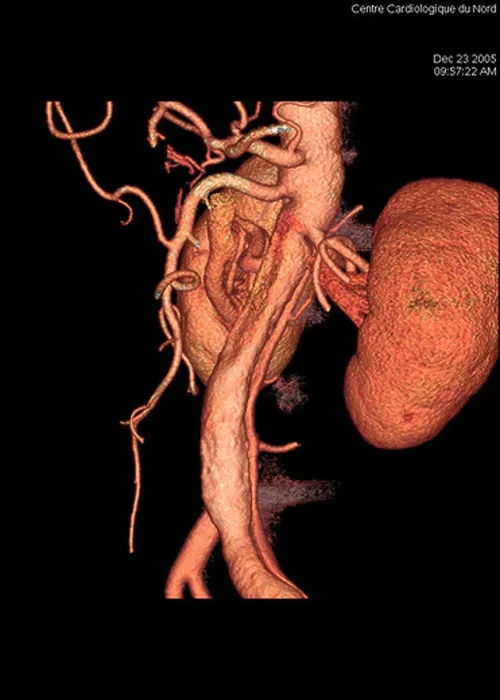 Gerahmter Druck : ANEURYSMA DER AORTA, 3D-SCAN Gerahmter Druck : ANEURYSMA DER AORTA, 3D-SCAN