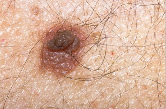 Gerahmter Druck : Mole (weicher Naevus) auf der Haut. Gerahmter Druck : Mole (weicher Naevus) auf der Haut.
