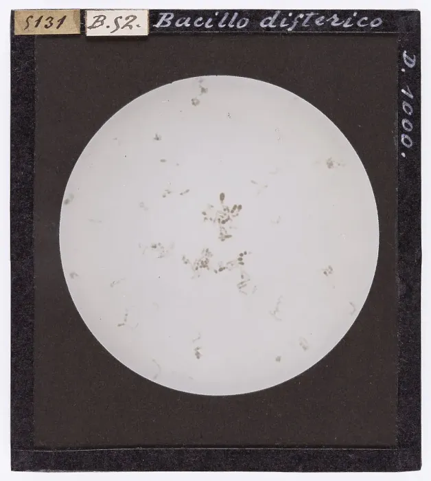 Gerahmter Druck : Bacillus diphtheriae unter dem Mikroskop Gerahmter Druck : Bacillus diphtheriae unter dem Mikroskop