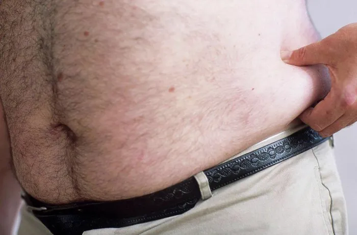 Gerahmter Druck : Obesity Gerahmter Druck : Obesity