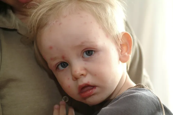Gerahmter Druck : Kind mit Mäusebiss Gerahmter Druck : Kind mit Mäusebiss