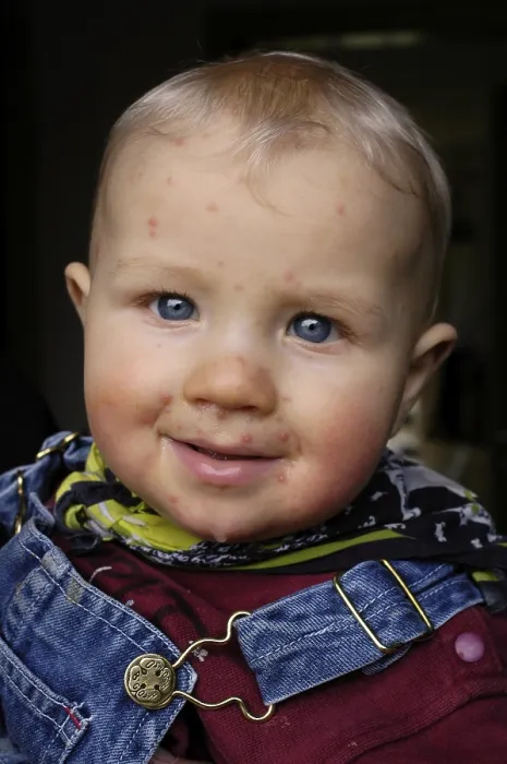 Gerahmter Druck : Kinder mit Windpocken. Gerahmter Druck : Kinder mit Windpocken.