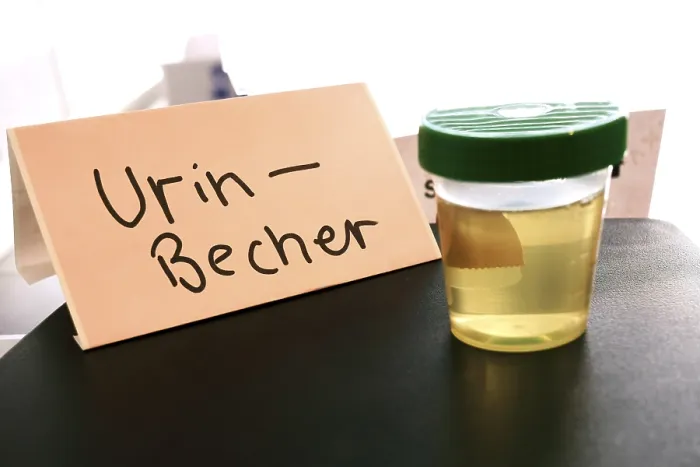 Gerahmter Druck : Ein Becher mit Urin, Urinprobe. Gerahmter Druck : Ein Becher mit Urin, Urinprobe.
