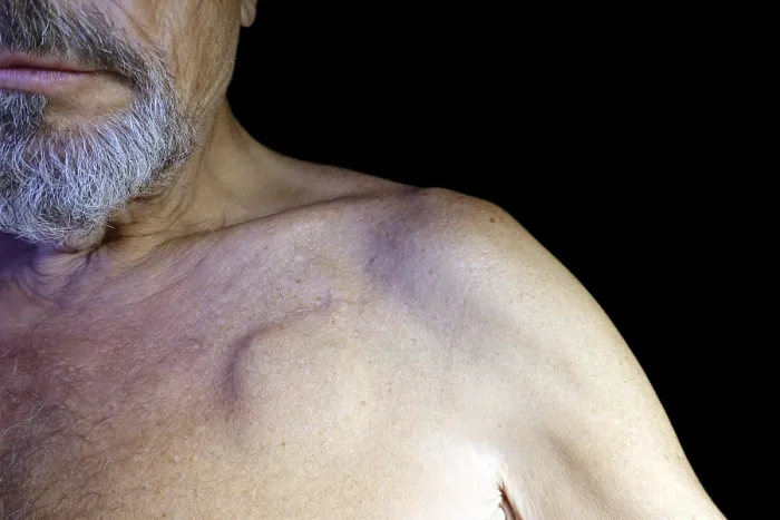 Gerahmter Druck : Alter Mann mit Herzschrittmacher, Studiofotografie auf schwarzem Hintergrund. Gerahmter Druck : Alter Mann mit Herzschrittmacher, Studiofotografie auf schwarzem Hintergrund.