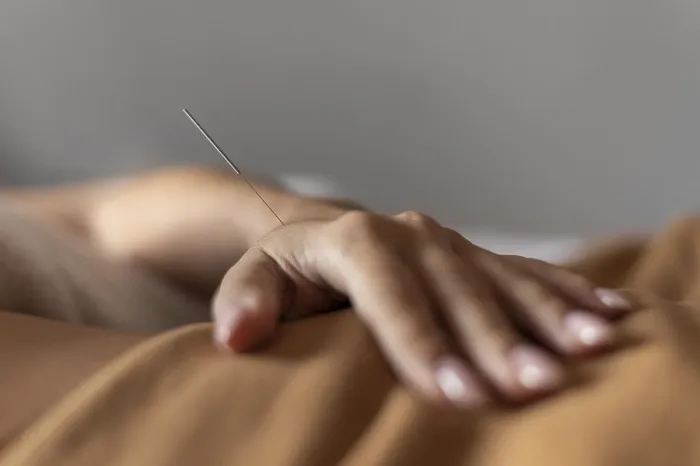 Gerahmter Druck : Hand mit Akupunkturnadel. Gerahmter Druck : Hand mit Akupunkturnadel.