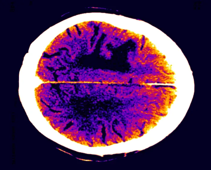 Gerahmter Druck : Hirnödem. Farbförderter CT-Scan des Gehirns, der Ödem Gerahmter Druck : Hirnödem. Farbförderter CT-Scan des Gehirns, der Ödem