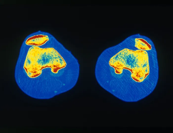 Gerahmter Druck : Knie, CT-Scan