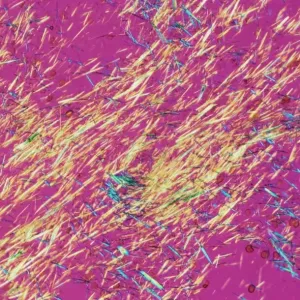 Gout Crystals Print, Polarised Light Micrograph Gout Crystals Print, Polarised Light Micrograph