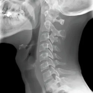 Cuello normal, rayos x