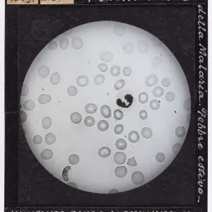 Ein Mikrofotograf von Plasmodium malaria, das bei der Untersuchung mit einem Mikroskop in vergrößerter Form sichtbar ist. Ein Mikrofotograf von Plasmodium malaria, das bei der Untersuchung mit einem Mikroskop in vergrößerter Form sichtbar ist.