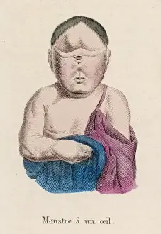 Limited Edition Prints Available Drucke: Child with One Eye