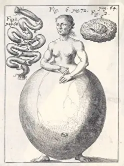 19th Century Medical Art Drucke: Hideous Deformity