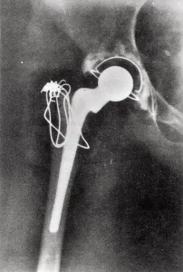 Bilder Aus Dem IMechE-Archiv Drucke: Röntgenbehandlung der Hüftgelenksersatzoperation