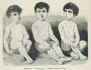 Historical Medical Images Drucke: Measles Compared