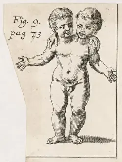 Zweiköpfiges Kind / 1691