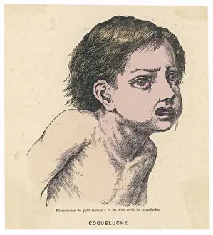 Mary Evans Prints Online Sale Drucke: Whooping Cough / 1883