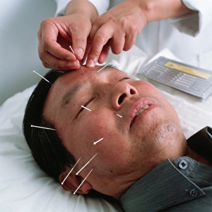 Acupuncture