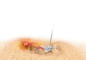 Acupuncture Treatment Drucke: Acupuncture, artwork