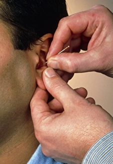 Acupuncture Treatment Drucke: Acupuncturists hands insert needle into mans ear