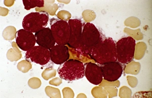 Akuter lymphozytärer Leukämie, Mikrograf