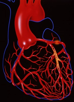 Bilder aus dem Jahr 1993: Angina Pectoris ist eine Erkrankung der Herzgefäße