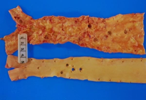 Bilder aus dem Jahr 1993: Aorten durch Atherosklerosis betroffen, eine normale Aorte