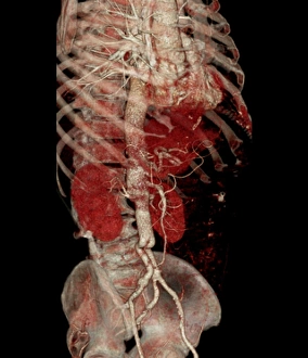 Vascular Disease Images Drucke: Aortic aneurysm CT scan