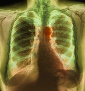 Vascular Disease Images Drucke: Aortic aneurysm, X-ray