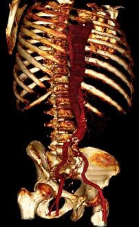 Drucke von Aortenruptur. 3D-Computertomographie (CT)-Bild eines 67-jährigen Mannes mit einer Aortenruptur. Die aorta ist der Körpers Hauptgefäß und läuft senkrecht nach unten in Mitte (rot) Bilder Datiert 2008 März: Aortenabschnitt, 3D-CT-Schnittstelle